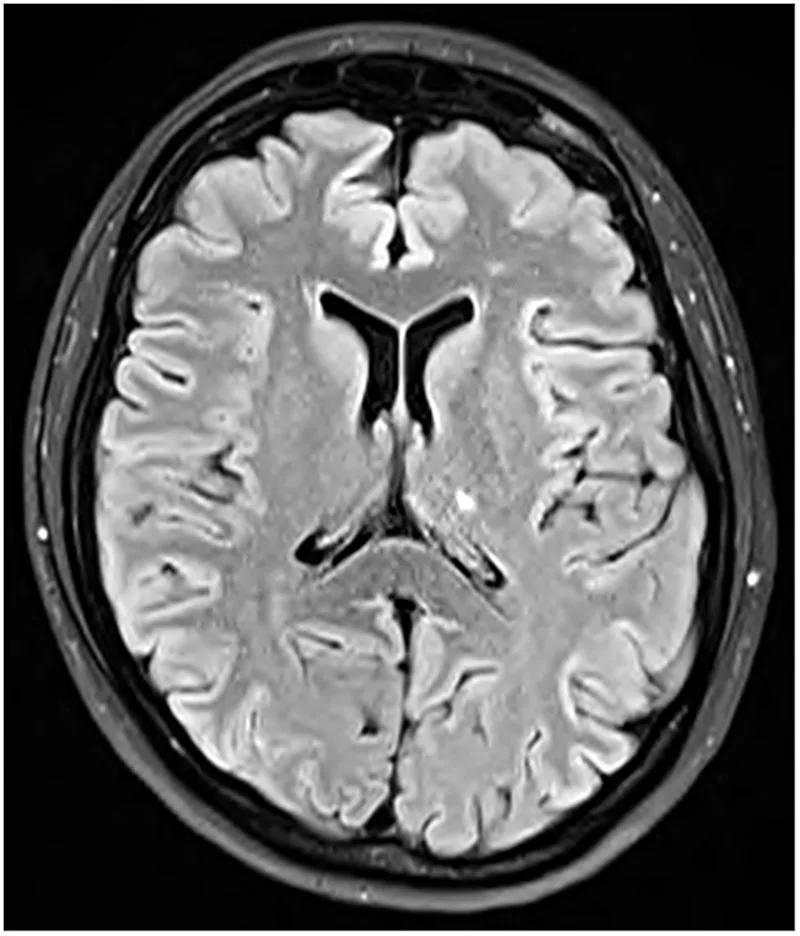 A patient, who was diagnosed with Stage IV Ovarian Cancer