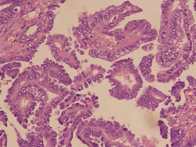 A patient, who was diagnosed with Ovarian Cancer