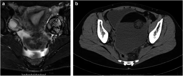 A patient, who was diagnosed with Stage I Ovarian Squamous Cell Carcinoma