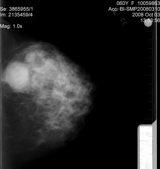 A patient, who was diagnosed with Stage IV Inflammatory Breast Cancer