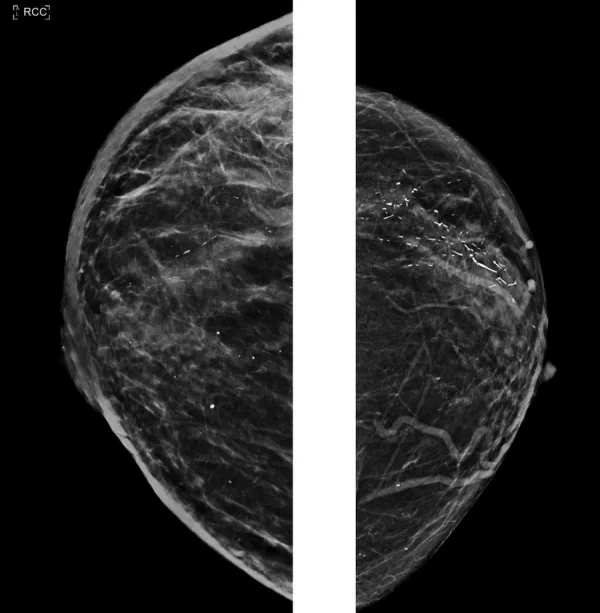 A patient, who was diagnosed with Stage IV Lung Adenocarcinoma