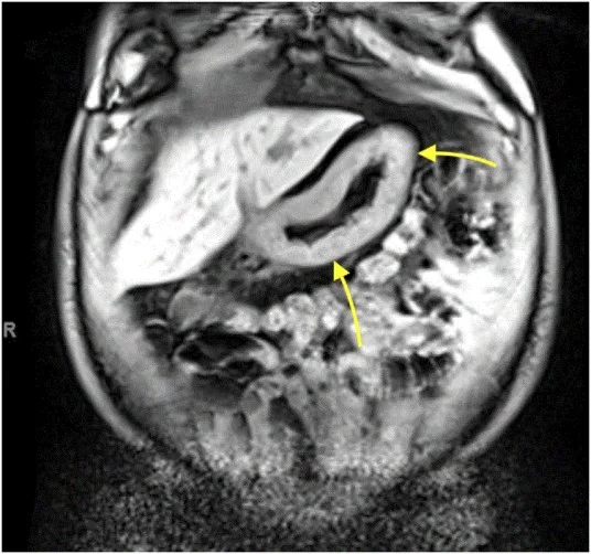 A patient, who was diagnosed with Stage IV Gastric Adenocarcinoma