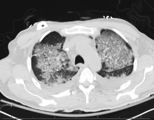 A patient, who was diagnosed with Breast Cancer