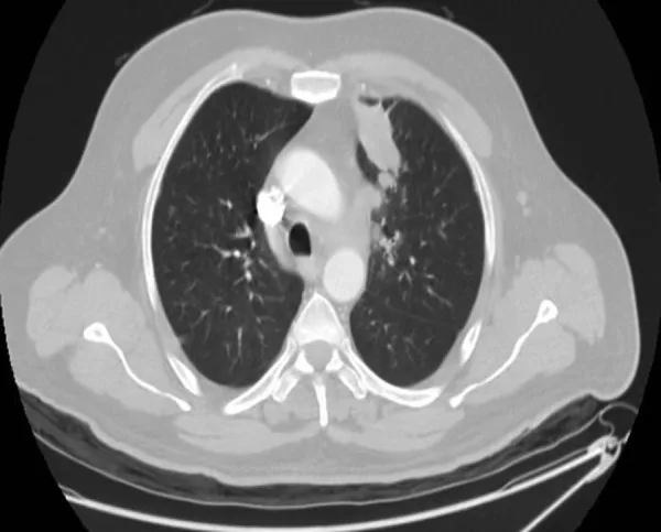 A patient, who was diagnosed with Lung Adenocarcinoma