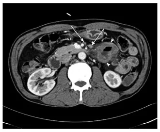 A patient, who was diagnosed with Stage I Gastric Adenocarcinoma