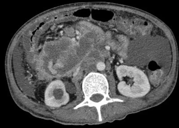 A patient, who was diagnosed with Stage III Colorectal Adenocarcinoma