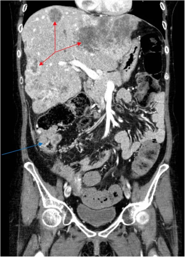 A patient, who was diagnosed with Colorectal Adenocarcinoma