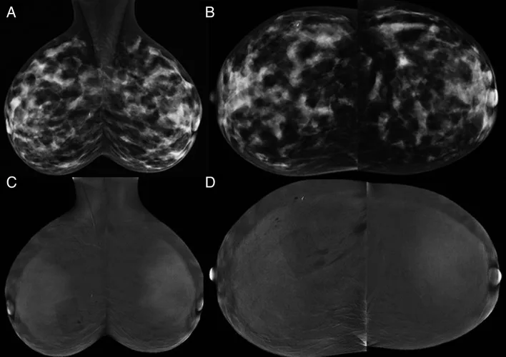 A patient, who was diagnosed with Invasive Ductal Carcinoma