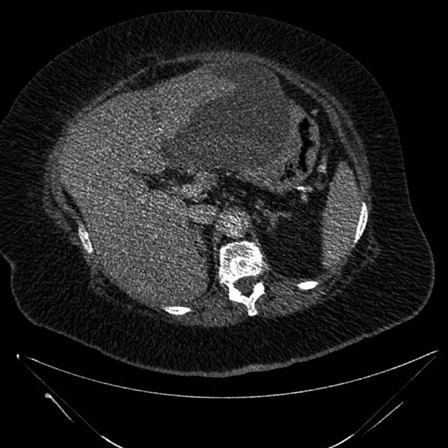 A patient, who was diagnosed with Colorectal Adenocarcinoma