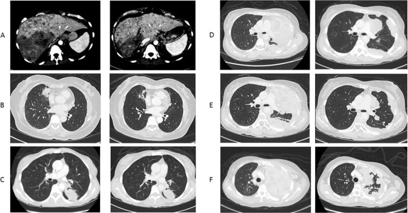 A patient, who was diagnosed with Stage IV Lung Adenocarcinoma