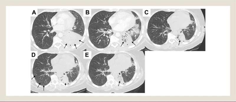 A patient, who was diagnosed with Stage IV Lung Adenocarcinoma