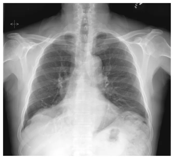 A patient, who was diagnosed with Lung Cancer