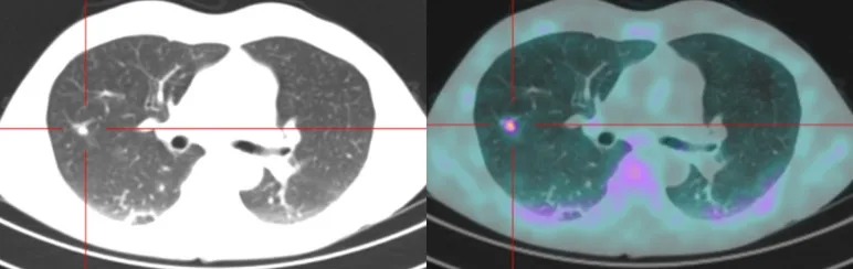 A patient, who was diagnosed with Lung Cancer