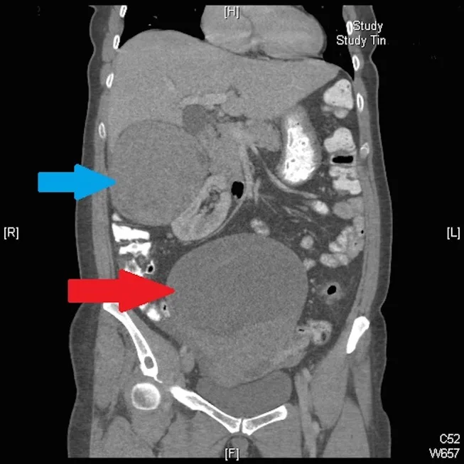 A patient, who was diagnosed with Stage I Ovarian Cancer