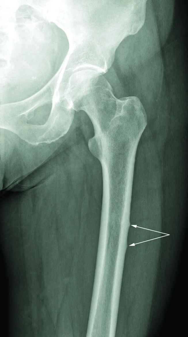A patient, who was diagnosed with Breast Cancer