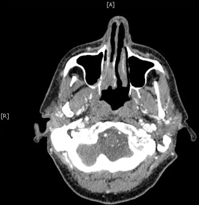 A patient, who was diagnosed with Small Cell Lung Cancer