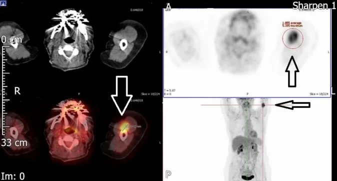 A patient, who was diagnosed with Stage IV Invasive Ductal Carcinoma