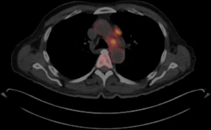 A patient, who was diagnosed with Small Cell Lung Cancer