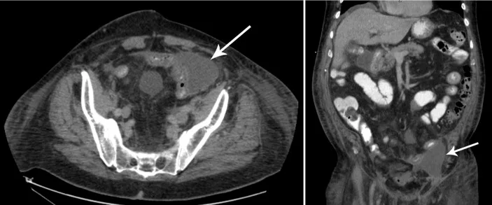 A patient, who was diagnosed with Stage I Colorectal Adenocarcinoma