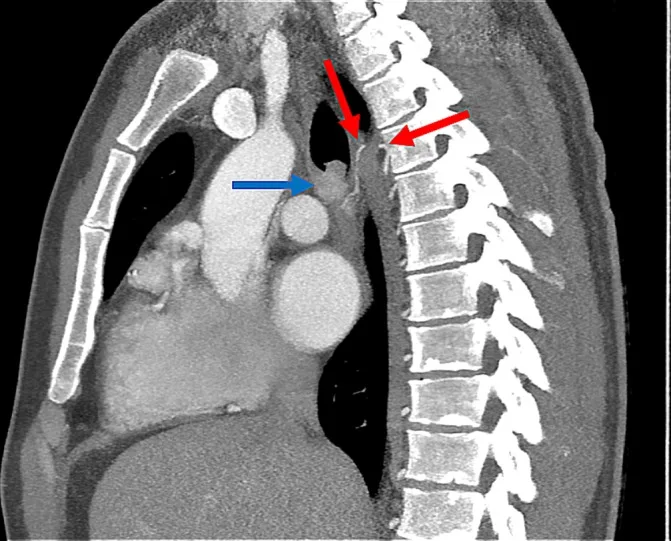 A patient, who was diagnosed with Lung Cancer