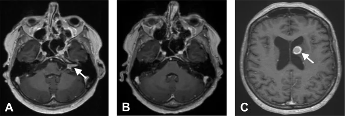 A patient, who was diagnosed with Stage IV Lung Adenocarcinoma