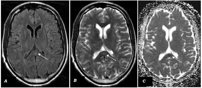 A patient, who was diagnosed with Stage IV Colorectal Adenocarcinoma