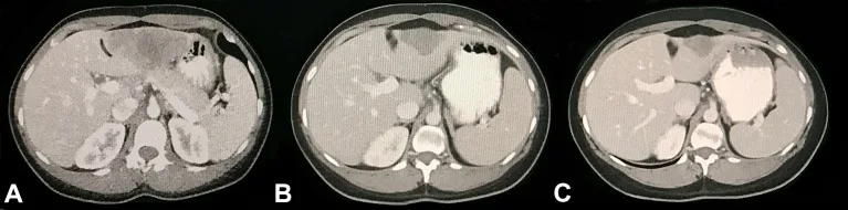 A patient, who was diagnosed with Stage IV Colorectal Adenocarcinoma
