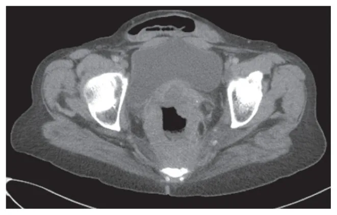 A patient, who was diagnosed with Colorectal Adenocarcinoma