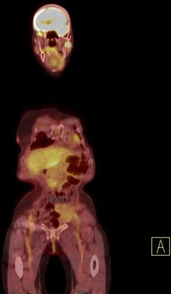 A patient, who was diagnosed with Stage IV Invasive Lobular Carcinoma