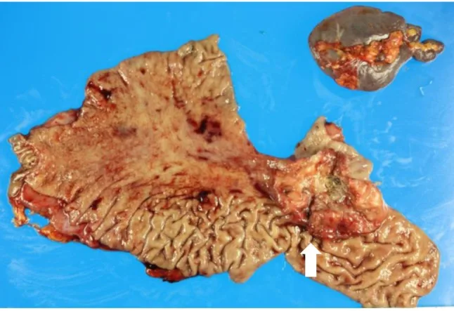 A patient, who was diagnosed with Stage IV Gastric Adenocarcinoma