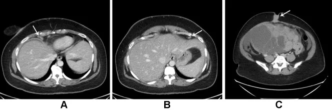 A patient, who was diagnosed with Stage IV Ovarian Cancer