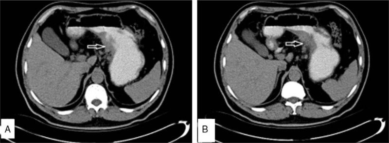 A patient, who was diagnosed with Stage II Gastric Adenocarcinoma