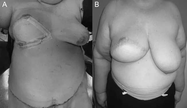 A patient, who was diagnosed with Stage I Invasive Ductal Carcinoma