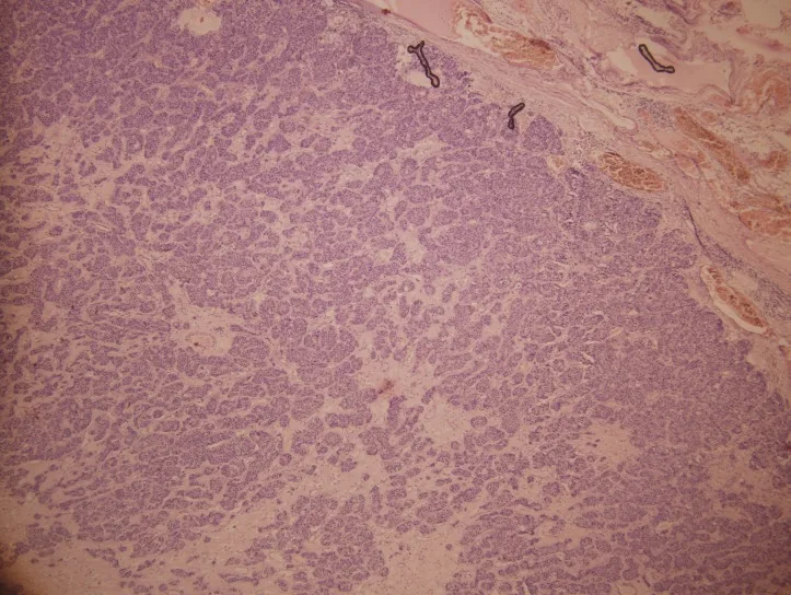 A patient, who was diagnosed with Stage III Breast Cancer