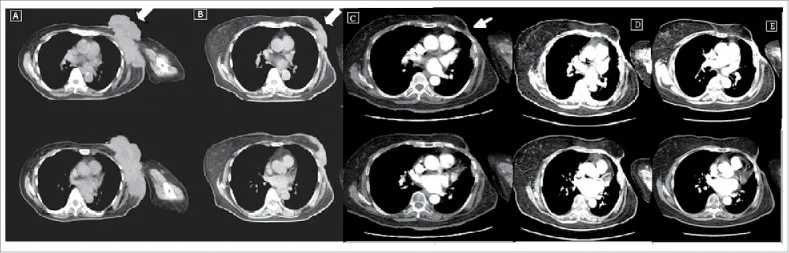 A patient, who was diagnosed with Stage IV Invasive Ductal Carcinoma
