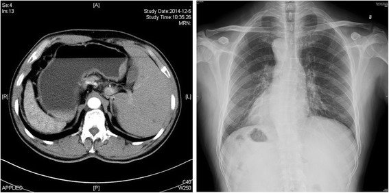 A patient, who was diagnosed with Gastric Adenocarcinoma