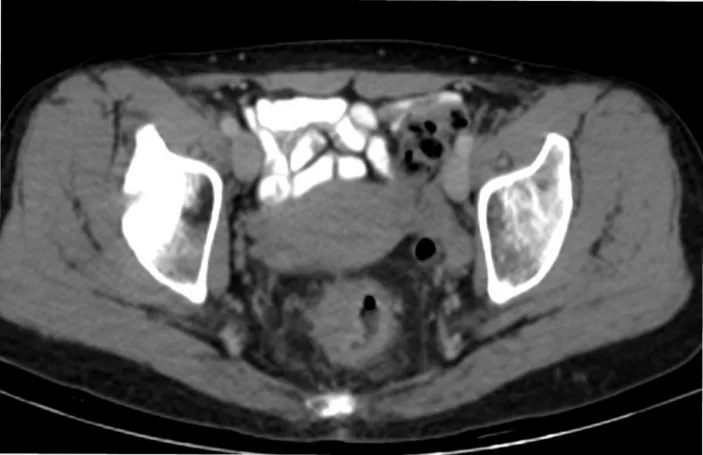 A patient, who was diagnosed with Colorectal Adenocarcinoma