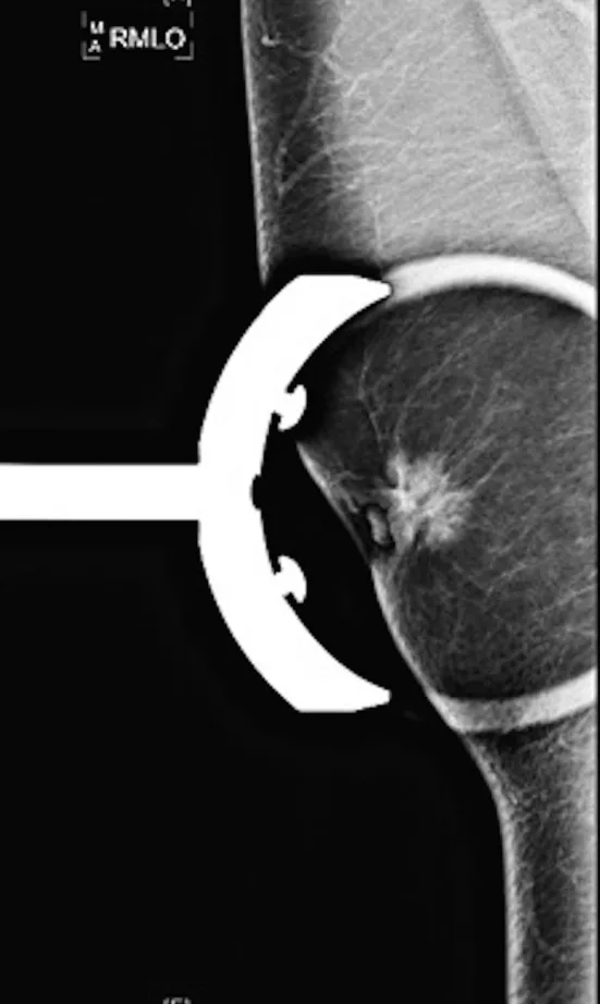 A patient, who was diagnosed with Stage II Breast Cancer