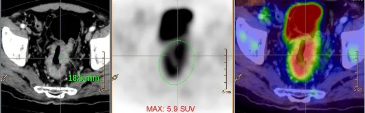 A patient, who was diagnosed with Stage II Colorectal Adenocarcinoma
