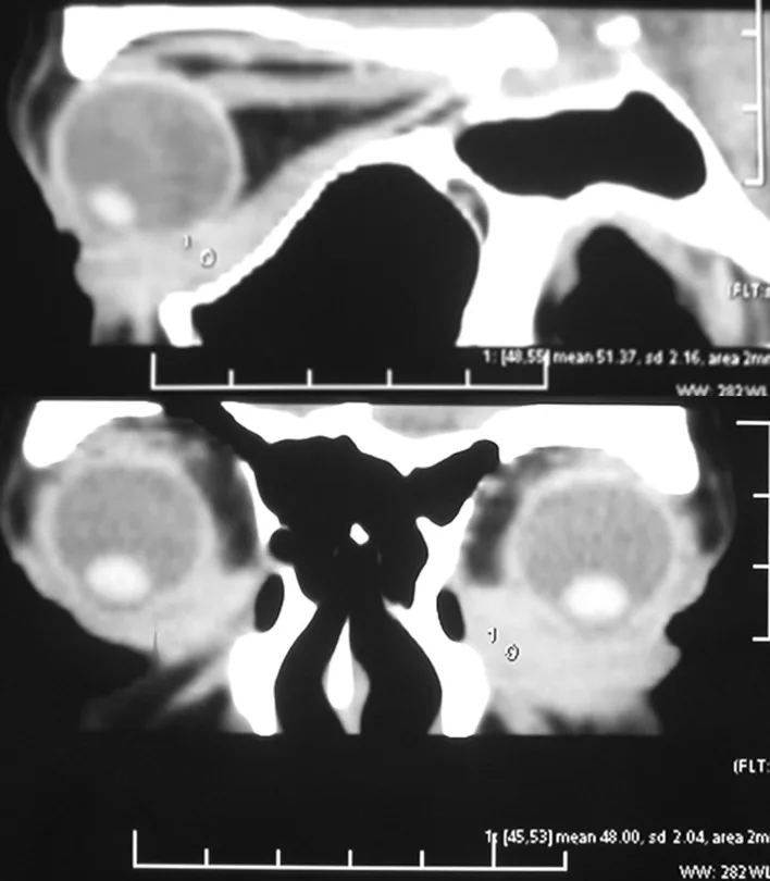 A patient, who was diagnosed with Stage IV Invasive Lobular Carcinoma