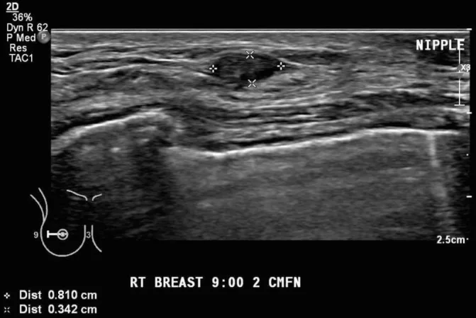 A patient, who was diagnosed with Stage II Invasive Ductal Carcinoma