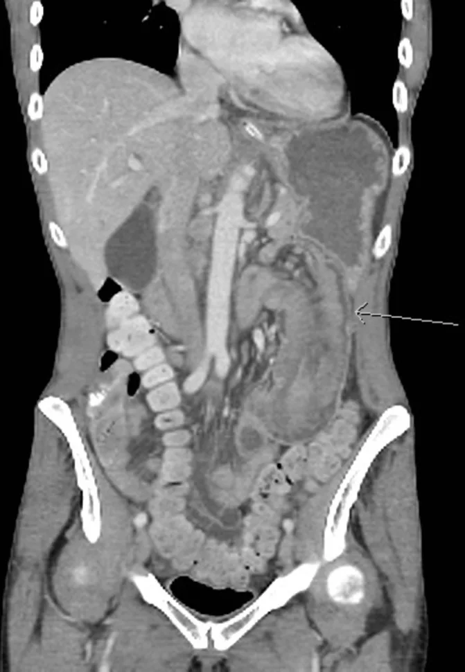 A patient, who was diagnosed with Stage IV Lung Adenocarcinoma