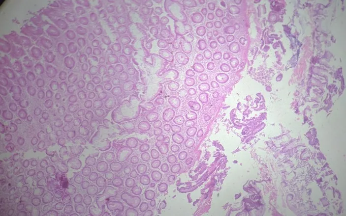 A patient, who was diagnosed with Stage III Colorectal Adenocarcinoma