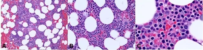 A patient, who was diagnosed with Stage IV Lung Adenocarcinoma