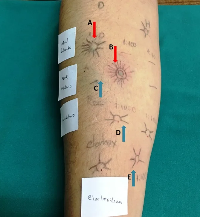 A patient, who was diagnosed with Invasive Ductal Carcinoma