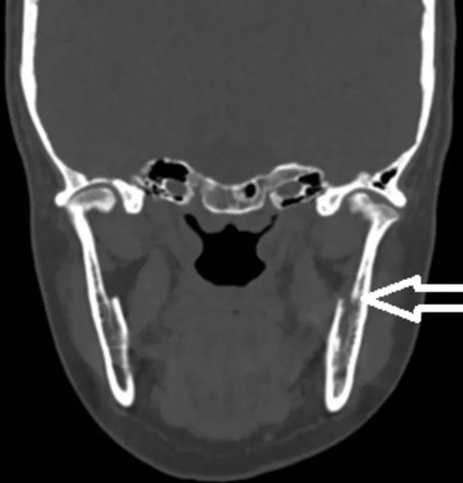 A patient, who was diagnosed with Stage IV Breast Cancer