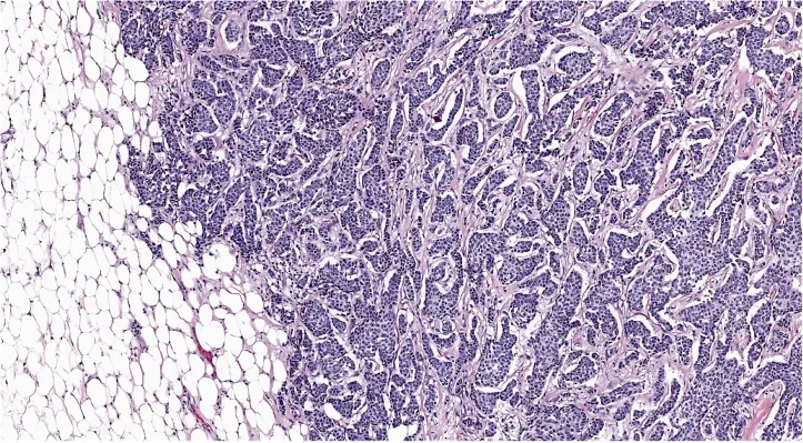 A patient, who was diagnosed with Stage IV Invasive Lobular Carcinoma