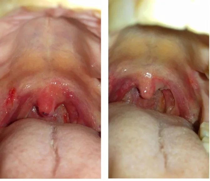 A patient, who was diagnosed with Invasive Ductal Carcinoma