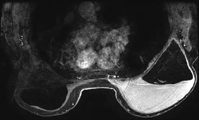 A patient, who was diagnosed with Breast Cancer