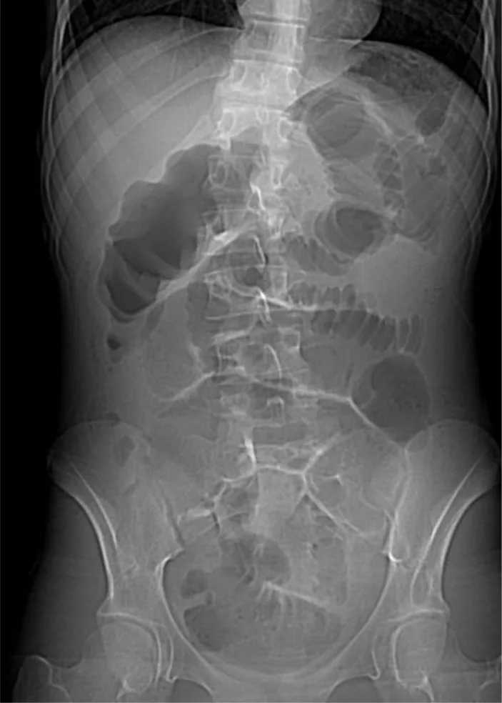 A patient, who was diagnosed with Stage III Colorectal Adenocarcinoma